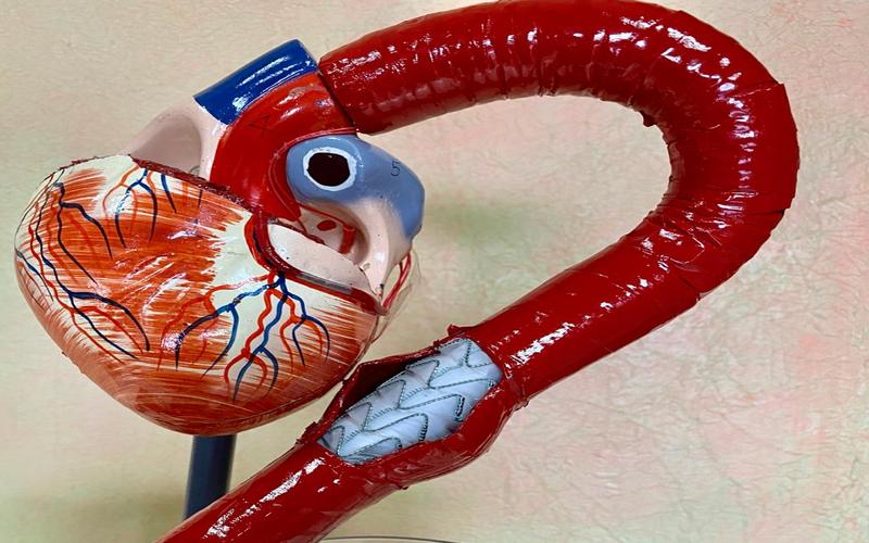i2i News Trivandrum,stent graft, health, sreechithra hospital, i2inews